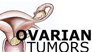 Ovarian Pathology amp Tumors [upl. by Nwadahs]