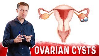 Screening of Ovarian Cancer [upl. by Inalaek]