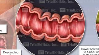 Bowel Perforation [upl. by Studley]