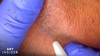 Electrolysis Permanently Removes Body Hair [upl. by Ehcsrop562]