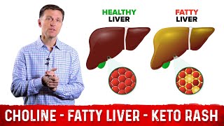 Choline One of The Best Vitamins for Fatty Liver – Dr Berg [upl. by Heyman]