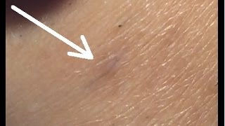 Electrolysis on Ingrown Hairs Step by Step [upl. by Arreit]