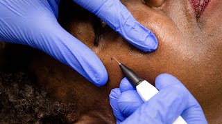 Skin Tags Removal with Electrolysis [upl. by Yardna]