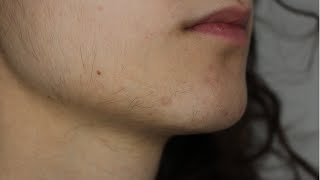 UPDATE 1 FACIAL HAIR ELECTROLYSIS VS LASER HAIR REMOVAL  PCOS [upl. by Dadirac]