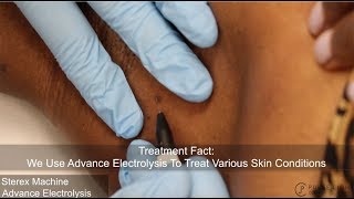 Skin Tag Electrolysis Procedure at Pulse Light Clinic London [upl. by Mogerly718]