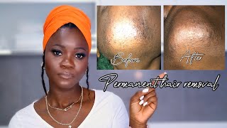 Update 1 My Electrolysis experience  Permanent hair removal  Electrolysis  Thatgirltameeza [upl. by Weiler]